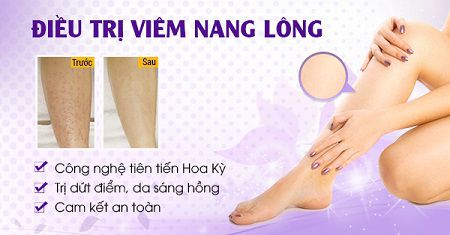 Điều trị viêm nang lông, không còn ngứa rát với Diode laser