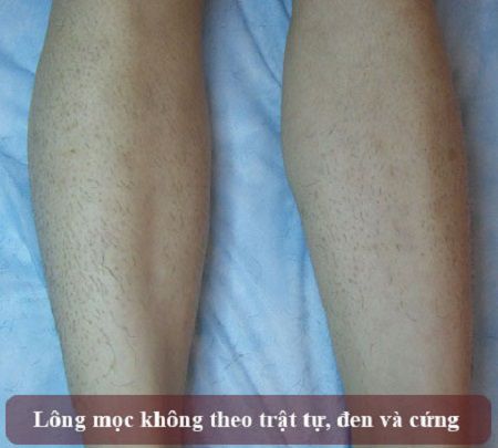 Tại sao bạn nên ngừng tẩy lông chân tay ngay lập tức?