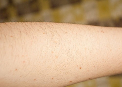 Chi phí tẩy lông chân vĩnh viễn tại TMV Kangnam hết bao nhiêu?