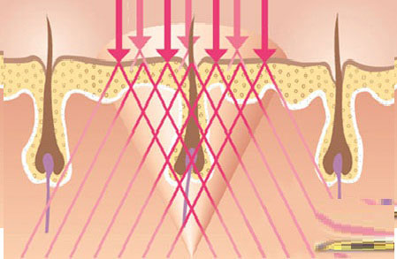 Quẳng gánh lo “violong” với công nghệ triệt lông mới nhất