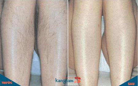 Mách bạn địa chỉ triệt lông vĩnh viễn ở Hà Nội tốt nhất