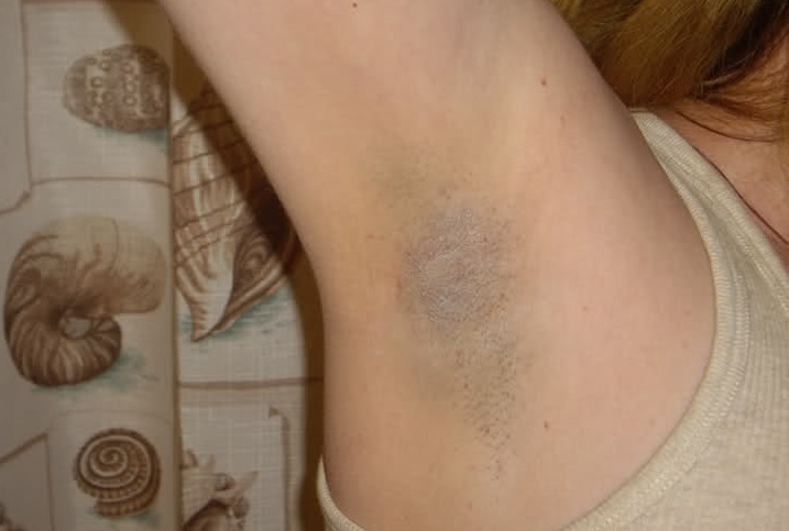 Mách Eva cách chữa vết thâm do wax lông nách tại nhà