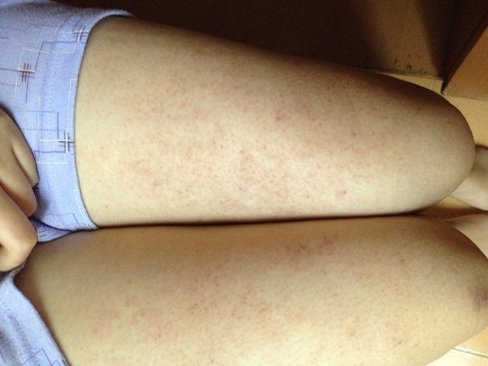 Cách trị viêm lỗ chân lông nào nhanh chóng và triệt để nhất?