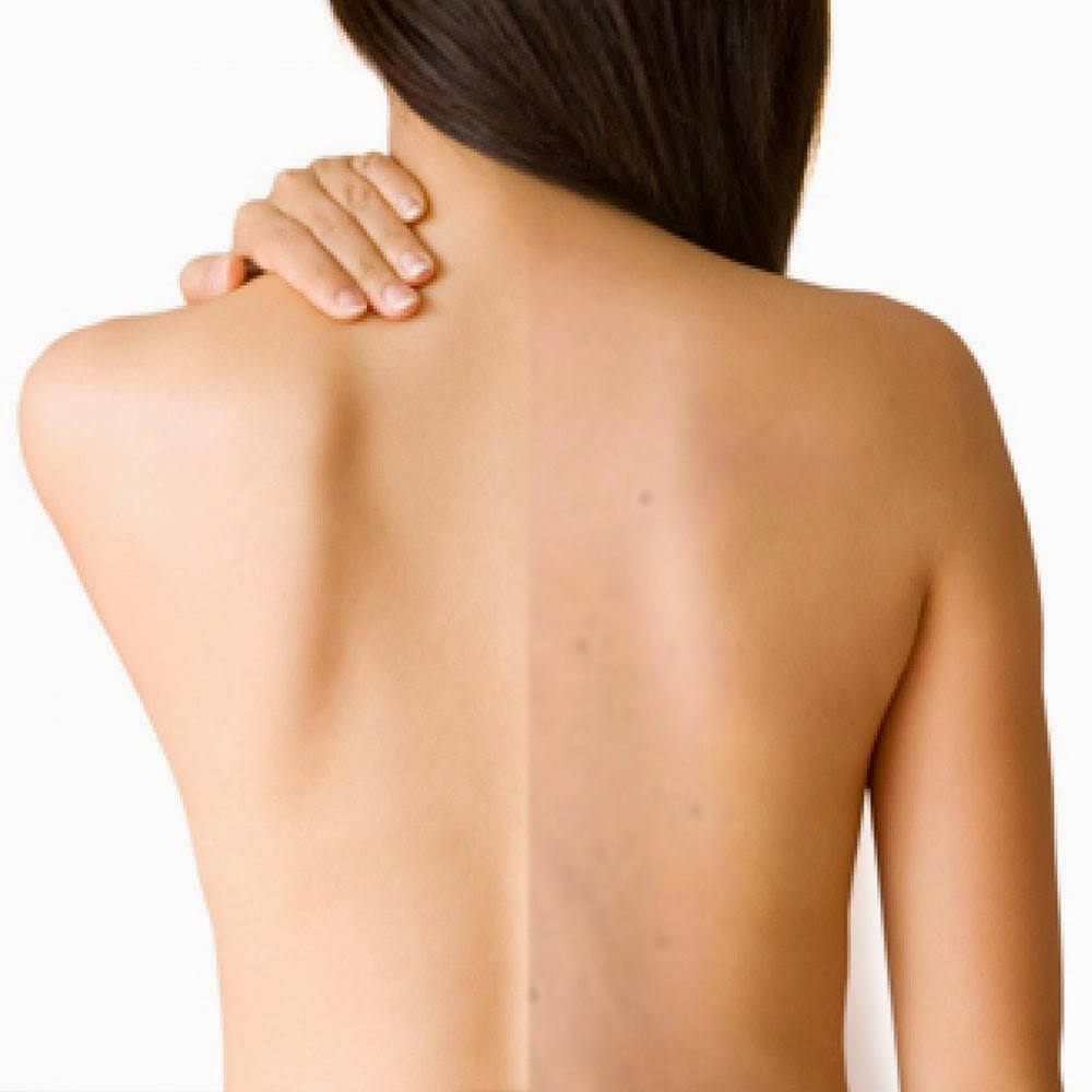Học cách trị viêm nang lông ở lưng tự tin đón hè
