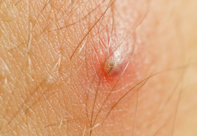 Lông mọc ngược là gì và cách chữa trị hiệu quả