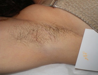 Học lỏm cách nhổ lông nách không đau tại nhà