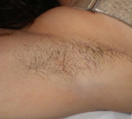 Tư vấn chuyên gia: Có nên triệt lông nách vĩnh viễn không?