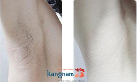 Cách waxing lông nách tại nhà an toàn và hiệu quả cho chị em