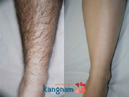 Cách tẩy lông chân bằng kem đánh răng tại nhà không lo mọc lại