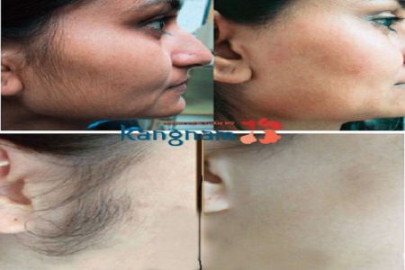 Là con gái có nên triệt lông mặt không?