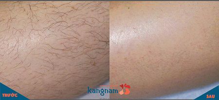 Cách tẩy lông tay vĩnh viễn được ưa chuộng nhất hiện nay