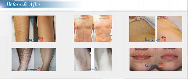 Công nghệ triệt lông vĩnh viễn LOẠI BỎ SẠCH LÔNG – TRẺ HÓA LÀN DA