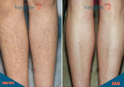 5 điều AI CŨNG PHẢI BIẾT trước khi đi triệt lông vĩnh viễn