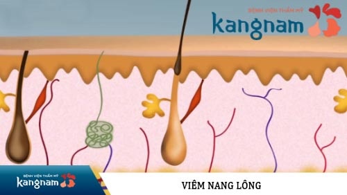 cách trị mụn viêm lỗ chân lông ở lưng