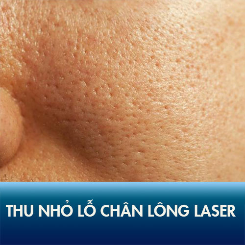 Thu nhỏ lỗ chân lông bằng Laser – Da sáng mịn đẹp sau 1 liệu trình