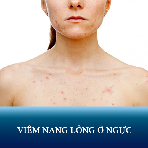 Nguyên nhân viêm nang lông ở ngực và cách điều trị dứt điểm 95% ngăn tái phát