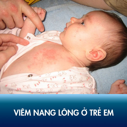 Viêm nang lông ở trẻ em: Triệu chứng bệnh lý, nguyên nhân và cách điều trị